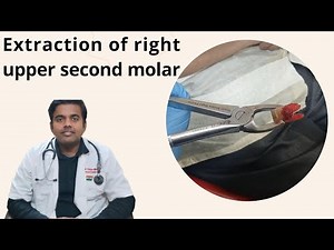 Right Upper Second Molar Extraction | Tooth Removal Procedure Explained Step-by-Step