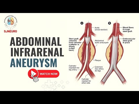 Abdominal Infrarenal Aneurysm | Endovascular Repair (EVAR) Procedure