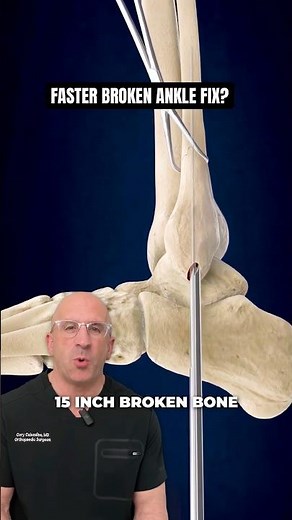 How Precision Nailing Heals Broken Ankles Better #ortho #medical #shorts