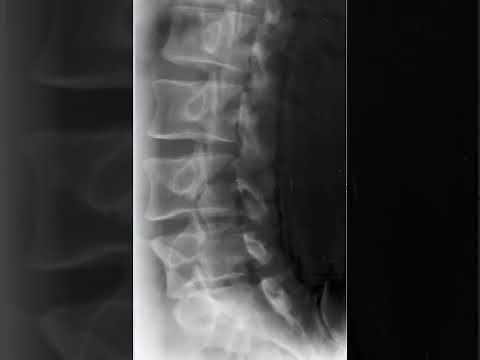 Lumbar Spine Oblique Radiology Tutorial