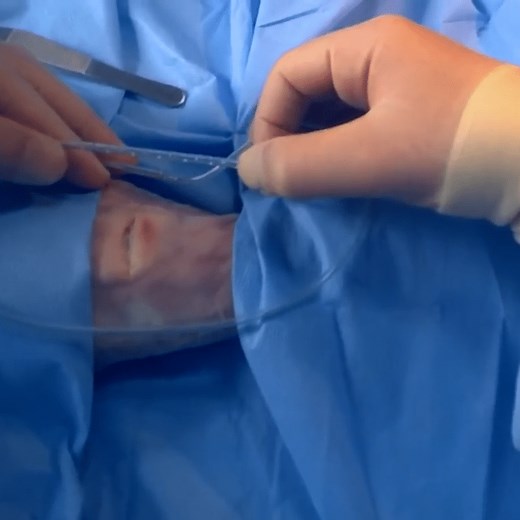 Insertion of a Surgical Drain - Indications - Procedure - TeachMeSurgery