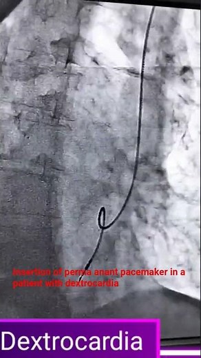 Permanent Pacemaker Implantation Step By Step In Dextrocardia 😱😱