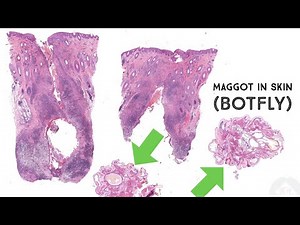 Botfly (fly larva/maggot in skin) dermatobia hominis tropical parasite myiasis pathology