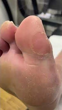 Watch a Podiatrist Remove Hard Skin and Calluses from Big Toe | Dry, Cracked Skin Treatment