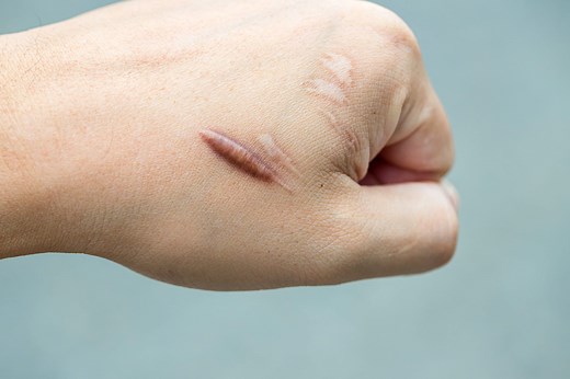 Dermatologists Explain Exactly How to Minimize the Look of Scars