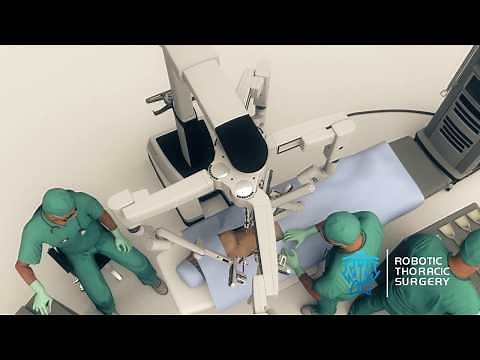 What Is a Robotic Lobectomy?