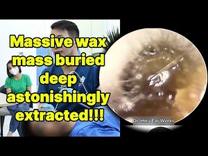 Massive wax mass buried deep astonishingly extract | ear cleaning | ASMR earwax | soothing |relax|