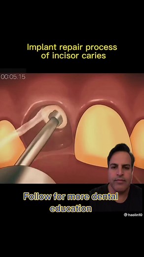 Dentistry explained episode 2. Implant restoration and placement to replace the missing front tooth, tooth is extracted, followed by bone grafting, followed by implant placement and a crown #greenscreenvideo #DentalStudent #Dentistry #tooth