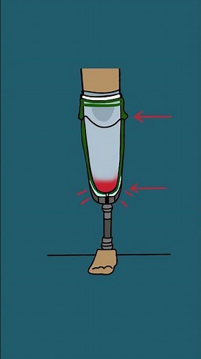 Tips and Tricks: Prosthetic Sock Ply Management #howto #tipsandtricks #tutorial