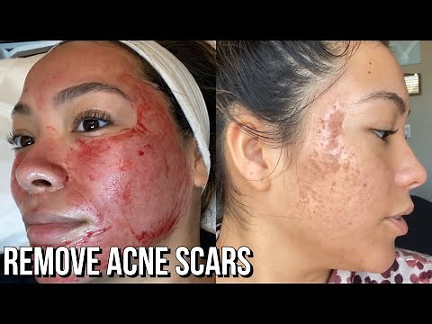 Second Round of Microneedling! #5 Before & After Results