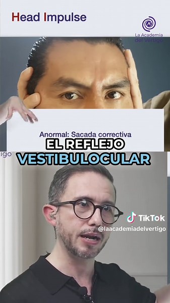 ¿Sabes interpretar el impulso cefálico? El Head Impulse Test es clave en el protocolo HINTS. En vértigo agudo, este signo puede decirte si el problema está en el oído… o en el sistema nervioso central. ✅ Si el impulso es anormal, es periférico. 🚨 Si es normal… ¡alerta! Podría ser un stroke. En este video te explicamos cómo se ve una respuesta normal y una anormal, y por qué este signo es tan importante. 🧠 En el próximo video: hablamos de nistagmus y qué buscar para diferenciar entre periférico