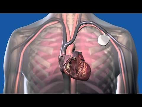 What Is a Defibrillator How Does It Work