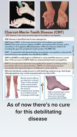 #charcotmarietooth #charcotmarietoothdisease #cmtawarnness #rarediseaseawareness #cmtawarnness #fypage #pleasesupport #nocure #nocure
