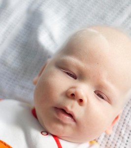 Nystagmus In Babies: Causes, Symptoms & 4 Treatment Options