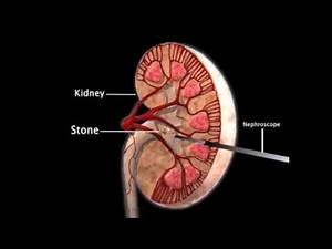 Percutaneous Nephrolithotomy
