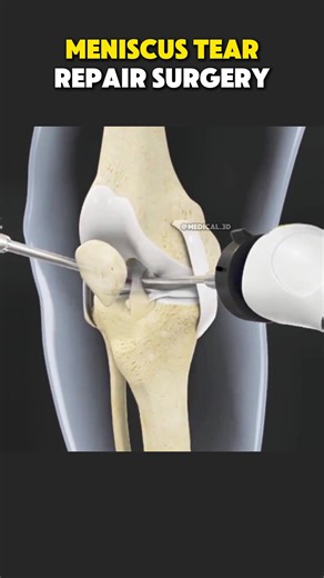 Meniscus Tear Repair Surgery (3D Animation) #meniscustear #meniscusrepair #meniscussurgery #meniscus #meniscalrepair