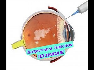 INTRAVITREAL INJECTION technique/ Procedure for giving INJECTIONS inside the EYE