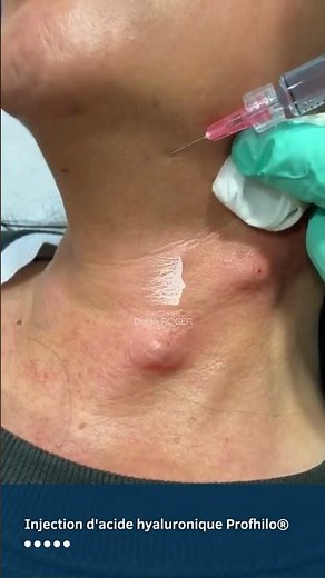 Injection d'acide hyaluronique Profhilo à Limoges®