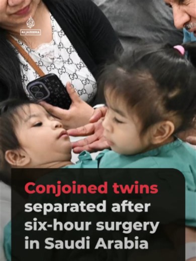 Filipino conjoined twins Olivia and Gianna were successfully separated during a six-hour surgery in Saudi Arabia. The operation carried out in six stages involved 22 specialised medical staff.