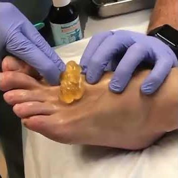 ganglion cyst of foot in this drained out || cyst removal