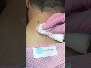 Cyst excision