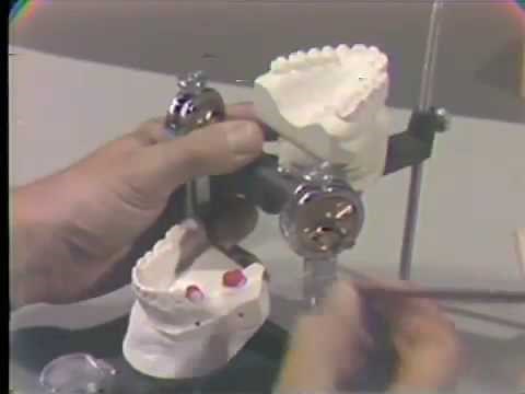 Rubber Base Impression, Duralay Coping, Removable Dies