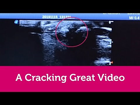 What happens when you crack your knuckles?