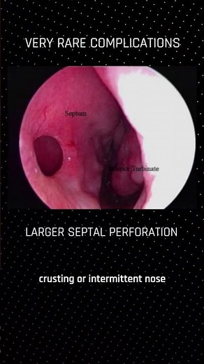 Short and long-term risks of septoplasty