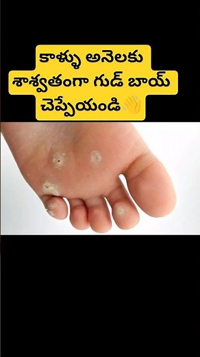 👉Say goodbye to corns forever👋how to get rid of corns |kichen tips #shorts #viral #yt