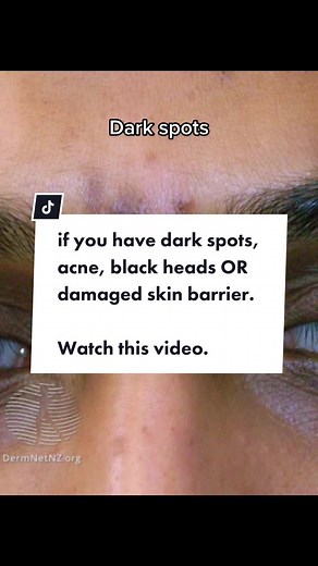 Part two? #blackheads #darkspots #acne #kbeauty #koreanskincare #skinbarrier #skincare #damagedskinbarrier