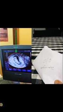 10 weeks Baby 😱😱