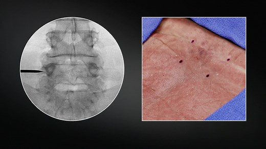 Medial Branch Nerve Transection Procedure