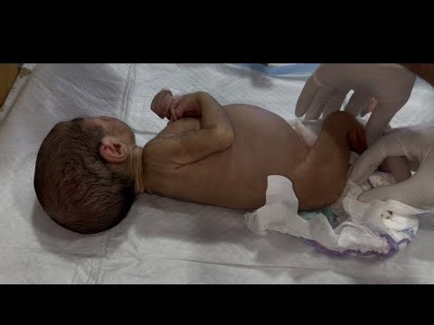 NEC Baby | Abdominal Distention Management | Suppository & NG Tube Procedure | NICU Care #baby