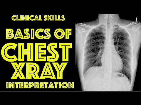 How To Read A Chest X-ray For Beginners - Dr. Gill