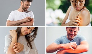 Eczema: NHS GP explains symptoms of skin condition