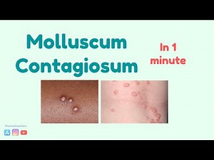 Molluscum Contagiosum: Causes, symptoms and treatment