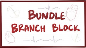 Bundle branch block: Video, Causes, & Meaning | Osmosis