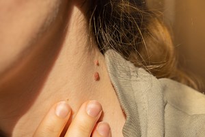 Experts Explain Why You Should Never Try to Remove a Skin Tag Yourself