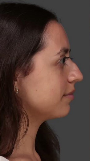 What to Expect After Rhinoplasty Surgery.