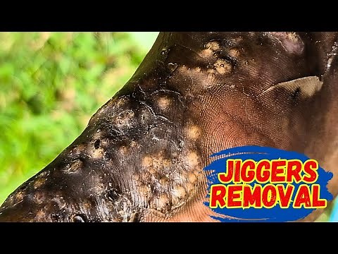 Jiggers Explained: Shocking Removal Methods & Prevention Tips 🚫