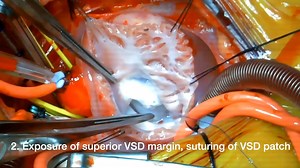 M - Two-patch transannular repair of tetralogy of Fallot w complete atriovent