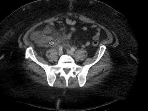 Acute Appendicitis