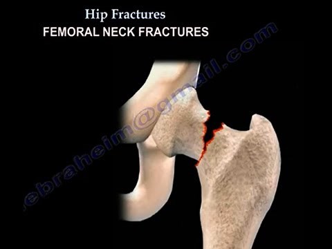 Hip Fractures types ,classification and treatment