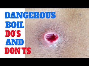 Furuncle | Infected boils | Dangerous boils | How to deal with skin abscess