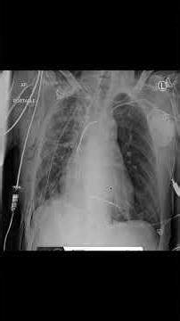 Chest X-RAY: Intensive Care Unit, Thorax Drainage, Emphysema, Pace Maker