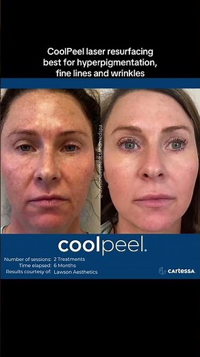 CoolPeel - best for hyperpigmentation, texture, fine lines and wrinkles. Before and after