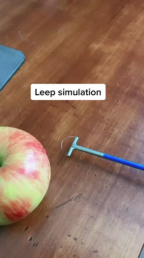 Understanding Colposcopy, LEEP, and Smear Procedures