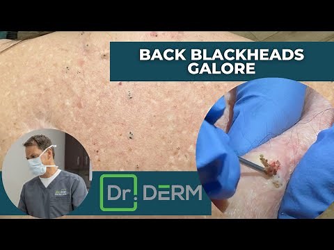 Back Blackheads Galore | Dr. Derm