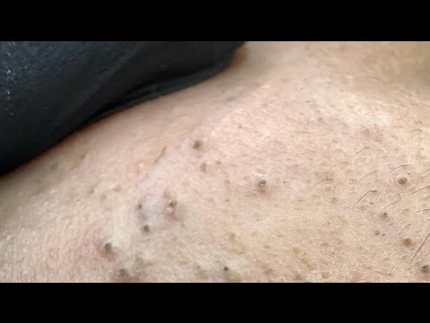 Satisfying Pore Extraction ASMR — Deep Cleansing & Large Blackhead Removal