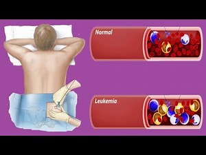 Leukemia Survival Rates: By Age